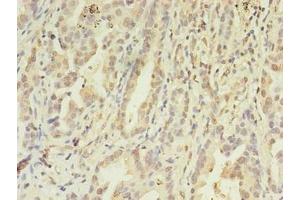 Immunohistochemistry of paraffin-embedded human lung cancer using ABIN7152867 at dilution of 1:100 (FGL2 antibody  (AA 24-439))