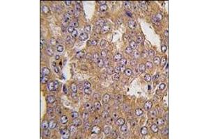 Formalin-fixed and paraffin-embedded human prostata carcinoma tissue reacted with NARS2 antibody (C-term), which was peroxidase-conjugated to the secondary antibody, followed by DAB staining. (NASP antibody  (C-Term))