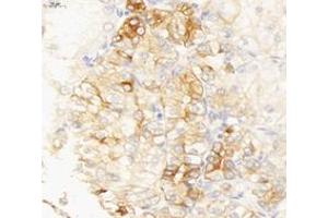 Immunohistochemistry analysis of paraffin-embedded human endometrial cancer using INSR (ABIN7074298) at dilution of 1: 6000 (ISR-alpha antibody)