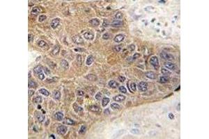 IHC analysis of FFPE human hepatocarcinoma tissue stained with STUB1 antibody (STUB1 antibody  (AA 203-231))