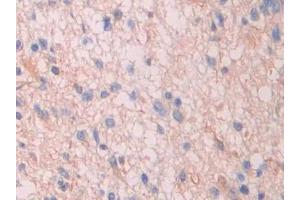 Detection of SAP in Human Glioma Tissue using Polyclonal Antibody to Serum Amyloid P Component (SAP)
