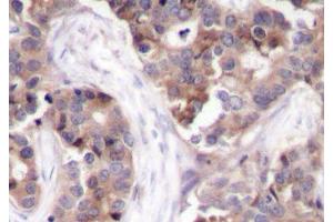 Immunohistochemistry of paraffin-embedded Human breast carcinoma using Phospho-STMN1(S25) Polyclonal Antibody (Stathmin 1 antibody  (pSer25))