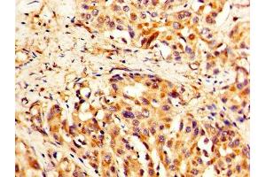 IHC image of ABIN7171484 diluted at 1:400 and staining in paraffin-embedded human liver cancer performed on a Leica BondTM system. (TLN1 antibody  (AA 92-399))