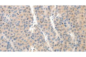 Immunohistochemistry of paraffin-embedded Human liver cancer tissue using SLC20A1 Polyclonal Antibody at dilution 1:40 (SLC20A1 antibody)