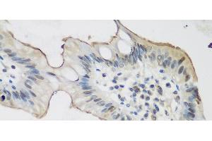 Immunohistochemistry of paraffin-embedded Human stomach cancer using ALOX15 Polyclonal Antibody at dilution of 1:200 (40x lens). (ALOX15 antibody)