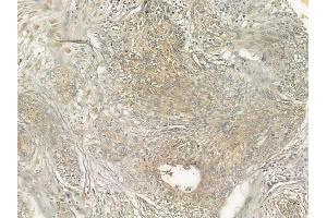 ABIN6266254 and ABIN6277415 at 1/100 staining human cervical carcinoma by IHC-P. (NFASC antibody  (C-Term))