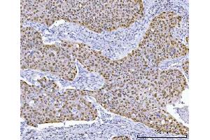 IHC analysis of TP53 using anti-TP53 antibody (ABIN7599050). (p53 antibody  (AA 1-186))