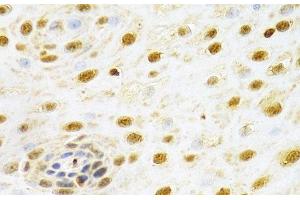 Immunohistochemistry of paraffin-embedded Human esophageal cancer using RUNX1 Polyclonal Antibody at dilution of 1:100 (40x lens). (RUNX1 antibody)
