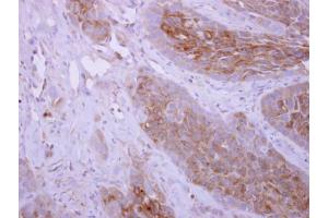 IHC-P Image DPYD antibody [N1N2], N-term detects DPYD protein at cytoplasm on H358 xenograft by immunohistochemical analysis. (DPYD antibody)