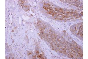 IHC-P Image DPYD antibody [N1N2], N-term detects DPYD protein at cytoplasm on H358 xenograft by immunohistochemical analysis.