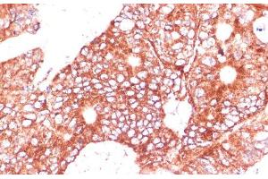 Immunohistochemistry of paraffin-embedded Human colon carcinoma using FAM98A Polyclonal Antibody at dilution of 1:100 (40x lens). (FAM98A antibody)