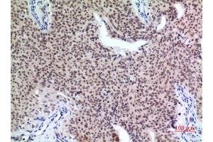 Immunohistochemistry (IHC) analysis of paraffin-embedded Human Mammary Cancer, antibody was diluted at 1:100. (P57 (Ser24) antibody)
