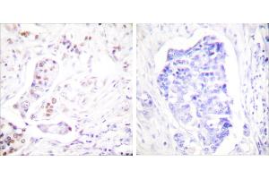 Peptide - +Immunohistochemical analysis of paraffin-embedded human breast carcinoma tissue using Cyclin A1 antibody (#C0166). (Cyclin A1 antibody)