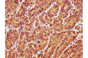 IHC image of ABIN7167090 diluted at 1:100 and staining in paraffin-embedded human liver cancer performed on a Leica BondTM system. (RANBP17 antibody  (AA 465-587))