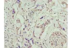 Immunohistochemistry of paraffin-embedded human pancreatic cancer using ABIN7173237 at dilution of 1:100 (TMEM53 antibody  (AA 1-170))