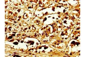 Immunohistochemistry of paraffin-embedded human melanoma using ABIN7146085 at dilution of 1: 100 (CD27 antibody  (AA 229-312))