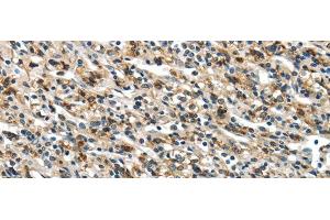 Immunohistochemistry of paraffin-embedded Human prostate cancer using GLP2R Polyclonal Antibody at dilution of 1/30 (GLP2R antibody)