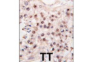 Formalin-fixed and paraffin-embedded human testicle tumor tissue reacted with HDAC11 polyclonal antibody  , which was peroxidase-conjugated to the secondary antibody, followed by DAB staining. (HDAC11 antibody  (C-Term))