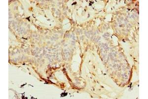 Immunohistochemistry of paraffin-embedded human breast cancer using ABIN7176140 at dilution of 1:100 (ZNF19 antibody  (AA 1-200))