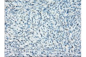 Immunohistochemical staining of paraffin-embedded Adenocarcinoma of breast tissue using anti-SSX2 mouse monoclonal antibody. (SSX2 antibody)