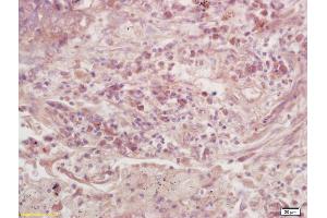 Formalin-fixed and paraffin embedded human colon carcinoma labeled with Anti-GNAO1/G0 Polyclonal Antibody, Unconjugated (ABIN872799) at 1:200 followed by conjugation to the secondary antibody and DAB staining. (GNAO1 antibody  (AA 221-320))