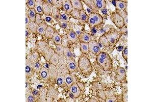 Immunohistochemical analysis of AP2-alpha-2 staining in human liver cancer formalin fixed paraffin embedded tissue section. (AP2A2 antibody)