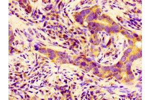 Immunohistochemistry of paraffin-embedded human pancreatic cancer using ABIN7145263 at dilution of 1:100 (BCAM antibody  (AA 447-547))