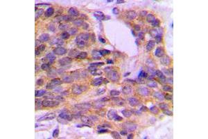 Immunohistochemical analysis of PKC theta (pS676) staining in human breast cancer formalin fixed paraffin embedded tissue section. (PKC theta antibody  (C-Term, pSer676))