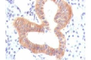 IHC testing of FFPE human melanoma with CD86 antibody (clone CDLA86). (CD86 antibody)