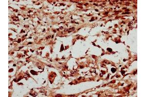 IHC image of ABIN7150959 diluted at 1:600 and staining in paraffin-embedded human melanoma performed on a Leica BondTM system. (NSMCE2 antibody  (AA 1-247))