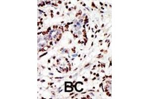 Formalin-fixed and paraffin-embedded human cancer tissue reacted with the primary antibody, which was peroxidase-conjugated to the secondary antibody, followed by AEC staining. (MLL/KMT2A antibody  (C-Term))