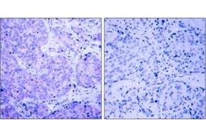 Immunohistochemistry (IHC) image for anti-3-phosphoinositide Dependent Protein Kinase-1 (PDPK1) (pSer241) antibody (ABIN2888512) (PDPK1 antibody  (pSer241))
