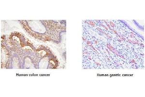 Paraffin embedded sections of human colon and gastric canitrocelluloseer tissue were initrocelluloseubated with anti-human EphA2 (1:100) for 2 hours at room temperature. (EPH Receptor A2 antibody  (AA 559-976))