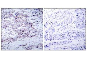 Immunohistochemical analysis of paraffin-embedded human breast carcinoma tissue using NF-κ,B p100(phospho- Ser870) antibody. (NFKB2 antibody  (pSer870))