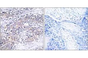 Immunohistochemistry analysis of paraffin-embedded human cervix carcinoma tissue, using CLN6 Antibody. (CLN6 antibody  (AA 221-270))