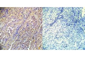 Immunohistochemical analysis of paraffin-embedded human lung carcinoma tissue using AMPKbeta1 (phospho-Ser182) (E012004). (PRKAB1 antibody  (pSer182))