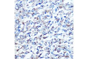 Immunohistochemistry of paraffin-embedded human liver cancer using OPTN Rabbit pAb (ABIN3015612, ABIN3015613, ABIN3015614 and ABIN6218972) at dilution of 1:100 (40x lens). (OPTN antibody  (AA 1-577))