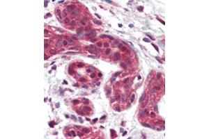 Formalin-fixed and paraffin-embedded human Breast tissue reacted with SLUG Antibody (Center) (ABIN6242822 and ABIN6577392) , which was peroxidase-conjugated to the secondary antibody, followed by AEC staining. (SLUG antibody  (AA 98-129))