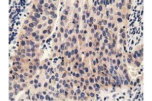 Immunohistochemical staining of paraffin-embedded Carcinoma of Human bladder tissue using anti-PRKD2 mouse monoclonal antibody.