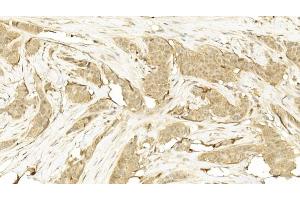 Immunohistochemical analysis of paraffin-embedded Human Breast cancer section using Pink1  8417b.