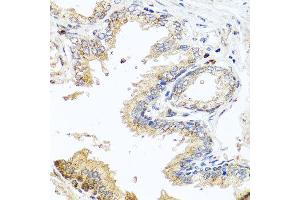Immunohistochemistry of paraffin-embedded human prostate using MCCC2 antibody at dilution of 1:100 (x40 lens). (MCCC2 antibody)