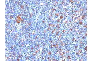 Formalin-fixed, paraffin-embedded human Hodgkin's Lymphoma stained with Fascin-1 Mouse Monoclonal Antibody (FSCN1/417) (Fascin antibody)