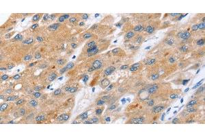 Immunohistochemistry of paraffin-embedded Human liver cancer tissue using ERVW-1 Polyclonal Antibody at dilution 1:45 (ERVW-1 antibody)