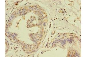 Immunohistochemistry of paraffin-embedded human breast cancer using ABIN7159241 at dilution of 1:100 (MLANA antibody  (AA 1-118))