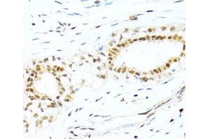 Immunohistochemistry of paraffin-embedded Human breast cancer using XRCC4 Polyclonal Antibody at dilution of 1:100 (40x lens). (XRCC4 antibody)