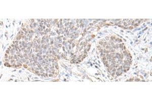 Immunohistochemistry of paraffin-embedded Human esophagus cancer tissue using TCF25 Polyclonal Antibody at dilution of 1:35(x200) (TCF25 antibody)