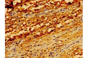 Immunohistochemistry of paraffin-embedded human melanoma using ABIN7173904 at dilution of 1: 100 (TRADD antibody  (AA 1-312))