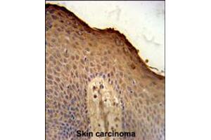 ISM1 Antibody immunohistochemistry analysis in formalin fixed and paraffin embedded human skin carcinoma followed by peroxidase conjugation of the secondary antibody and DAB staining. (ISM1 antibody  (C-Term))