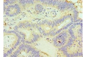 Immunohistochemistry of paraffin-embedded human colon cancer using ABIN7154051 at dilution of 1:100 (GLRX3 antibody  (AA 1-335))
