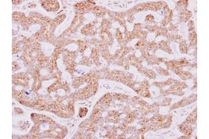 IHC-P Image RPL15 antibody detects RPL15 protein at cytosol on human breast carcinoma by immunohistochemical analysis. (RPL15 antibody)